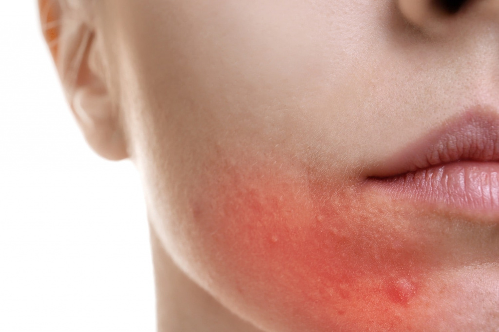 Аллергия на нервной почве: почему возникает и как с ней справиться