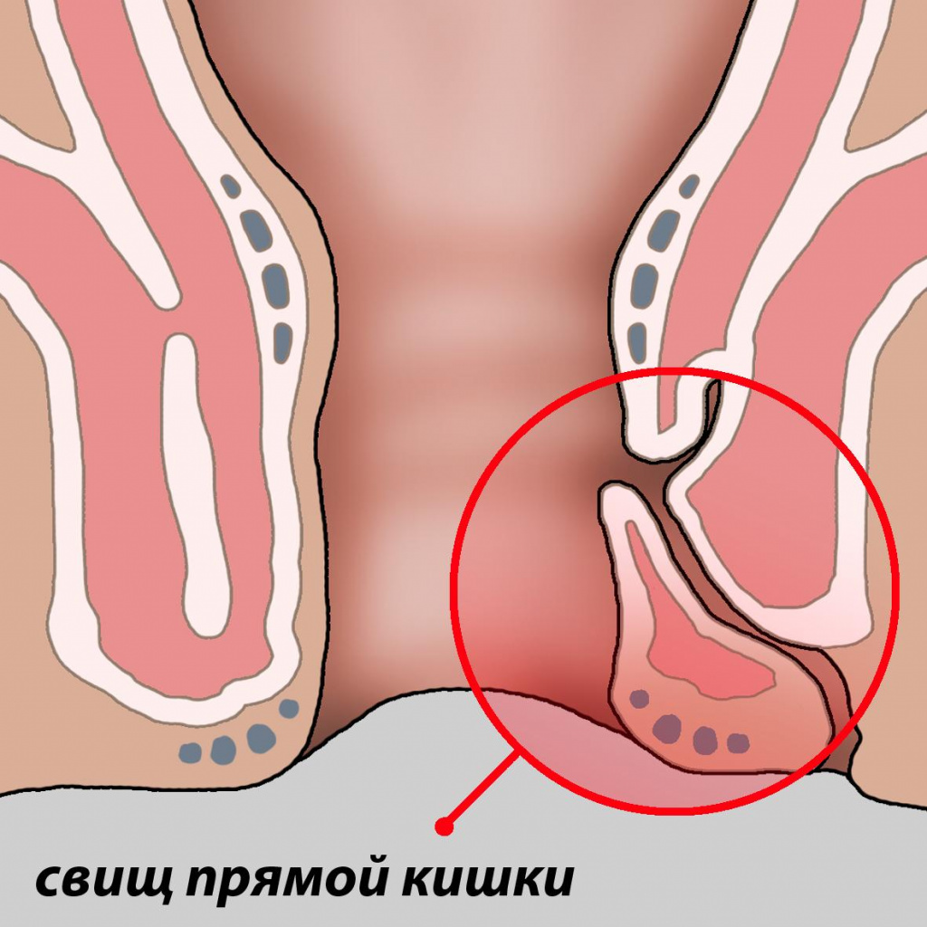 issechenie-svishchej issechenie-svishchej