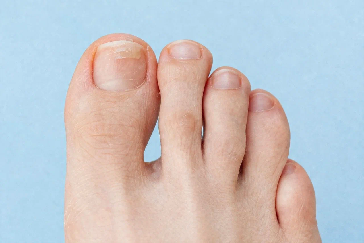 simptomy gribka nogtej