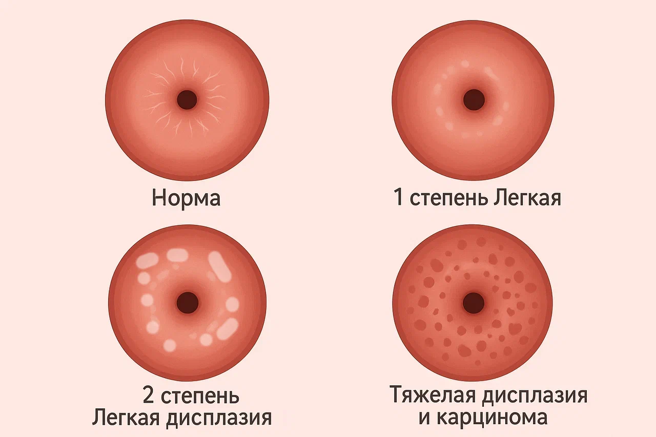 Дисплазия шейки матки Дисплазия шейки матки