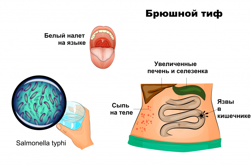 bryushnoj-tif1