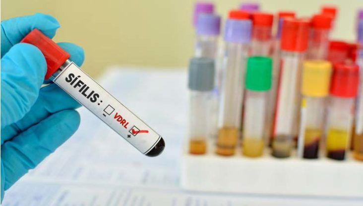 анализ крови на сифилис