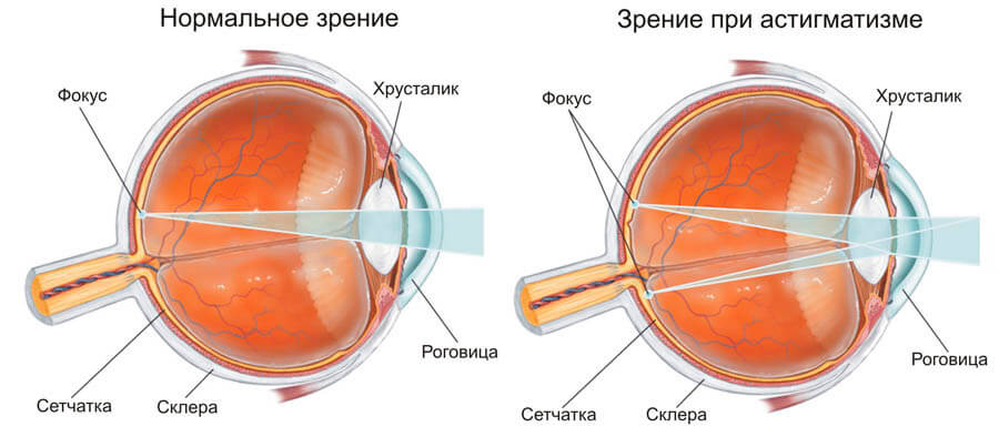 Виды рефракции глаза